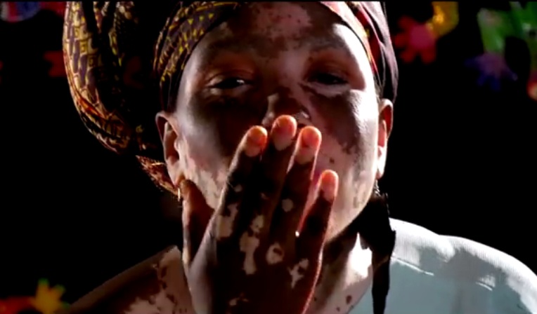 model_wuth_vitiligo.jpg