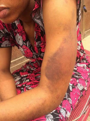 woman-beaten-black-and-blue