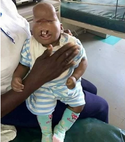 This is the child who was abandoned at a Kisumu hospital by the parents just because he had a deformity..so sad