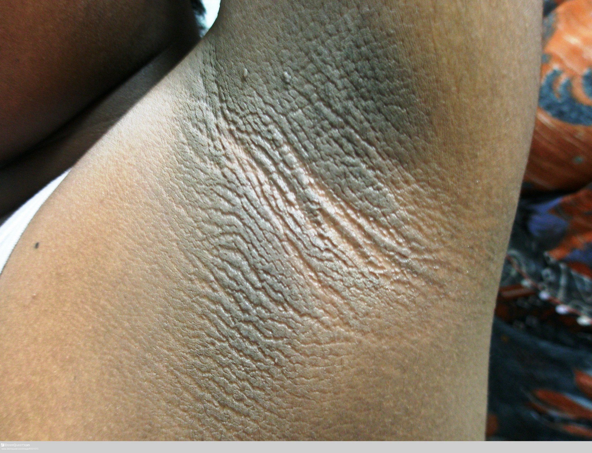 5 Home Remedies To Get Rid Of Dark Underarms/Armpits