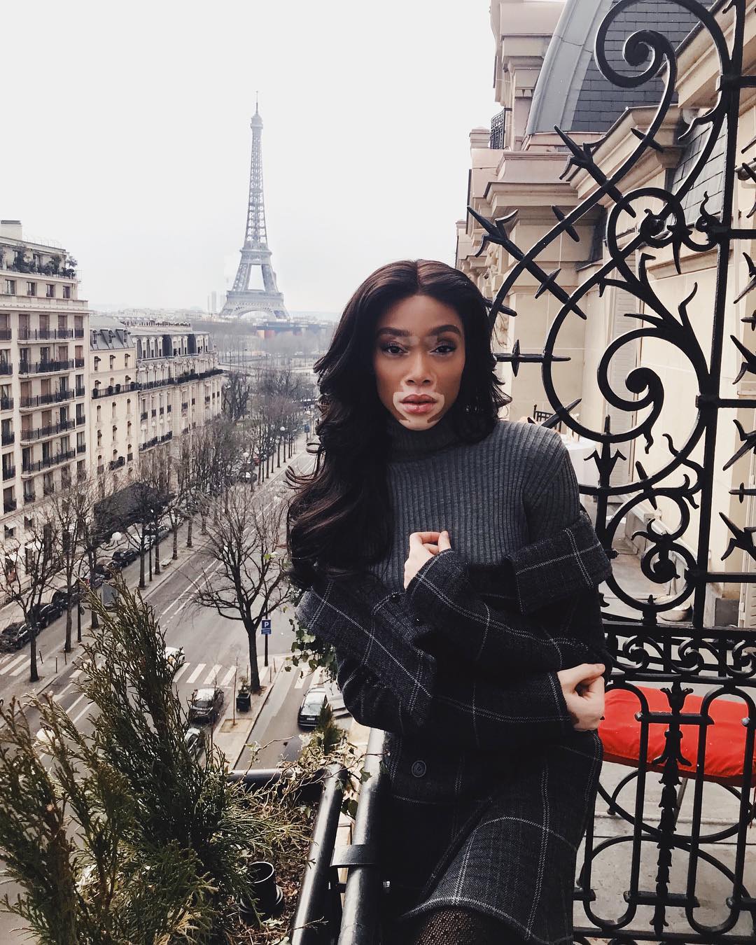 Winnie Harlow not Vitiligo sufferer
